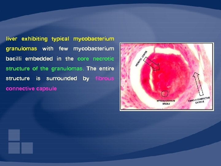 liver exhibiting typical mycobacterium granulomas with few mycobacterium bacilli embedded in the core necrotic