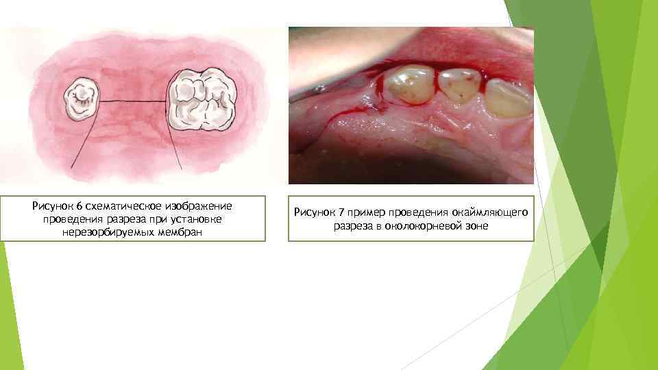 Рисунок 6 схематическое изображение проведения разреза при установке нерезорбируемых мембран Рисунок 7 пример проведения