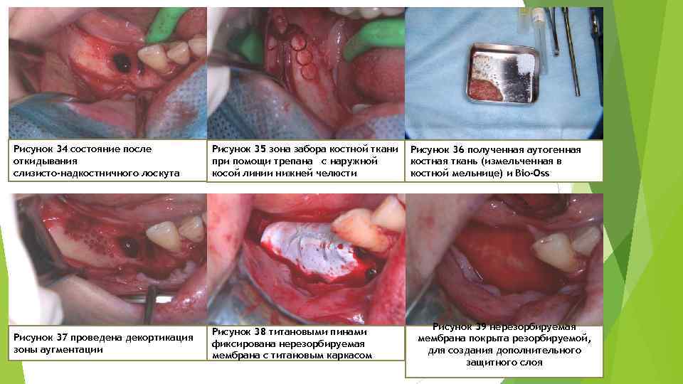 Рисунок 34 состояние после откидывания слизисто‐надкостничного лоскута Рисунок 35 зона забора костной ткани при