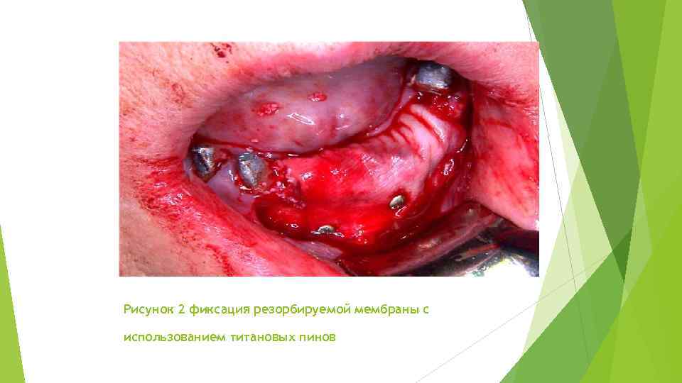 Рисунок 2 фиксация резорбируемой мембраны с использованием титановых пинов 