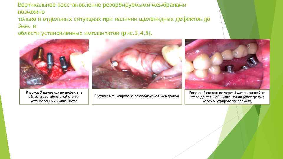 Вертикальное восстановление резорбируемыми мембранами возможно только в отдельных ситуациях при наличии щелевидных дефектов до