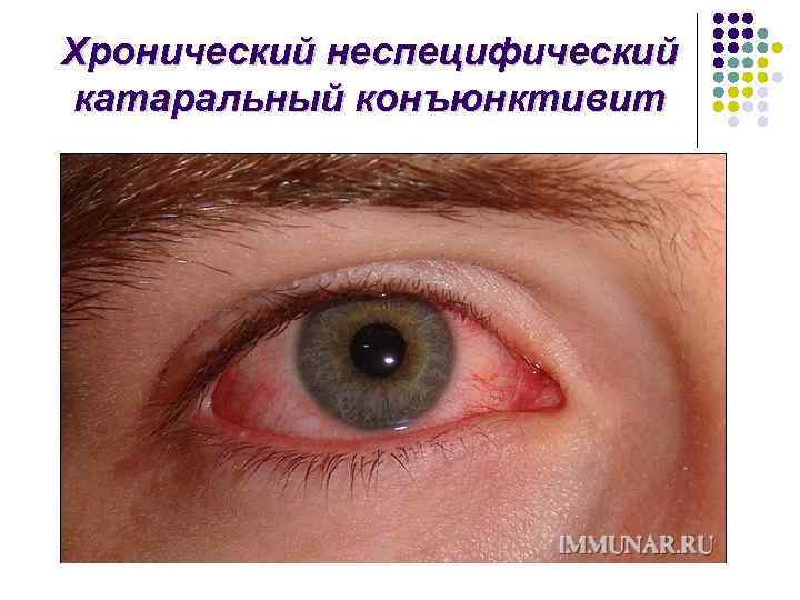 Хронический неспецифический катаральный конъюнктивит 