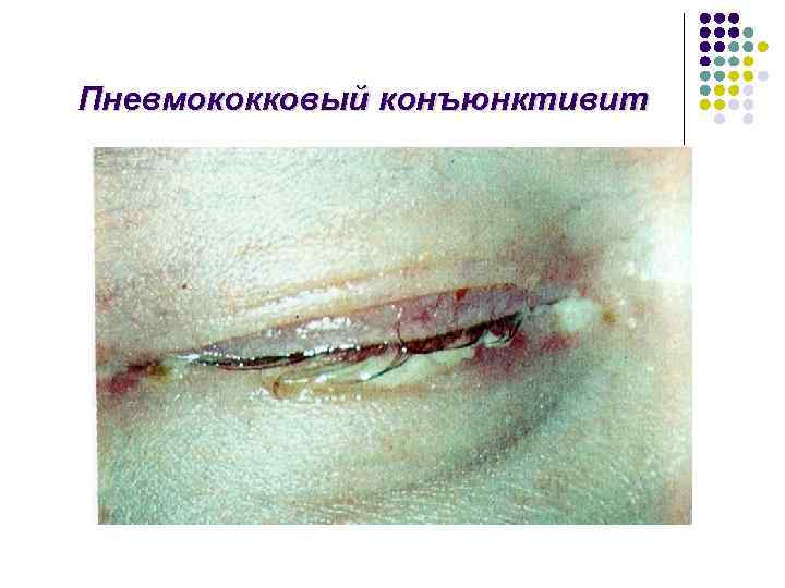 Пневмококковый конъюнктивит 