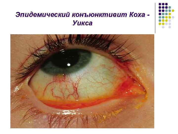Эпидемический конъюнктивит Коха Уикса 