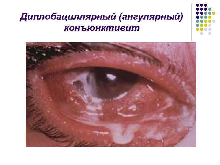 Диплобациллярный (ангулярный) конъюнктивит 
