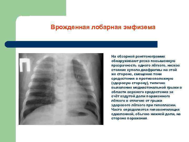 Врожденная лобарная эмфизема На обзорной рентгенограмме обнаруживают резко повышенную прозрачность одного лёгкого, низкое стояние