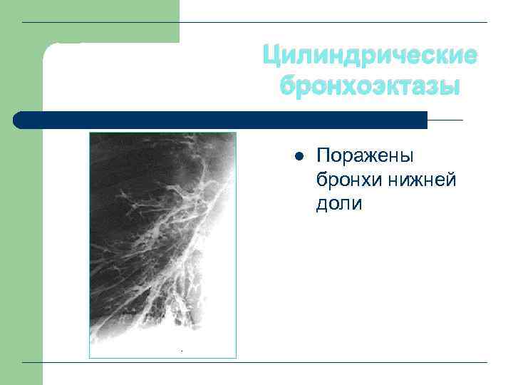 Цилиндрические бронхоэктазы l Поражены бронхи нижней доли 
