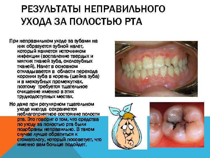 РЕЗУЛЬТАТЫ НЕПРАВИЛЬНОГО УХОДА ЗА ПОЛОСТЬЮ РТА При неправильном уходе за зубами на них образуется