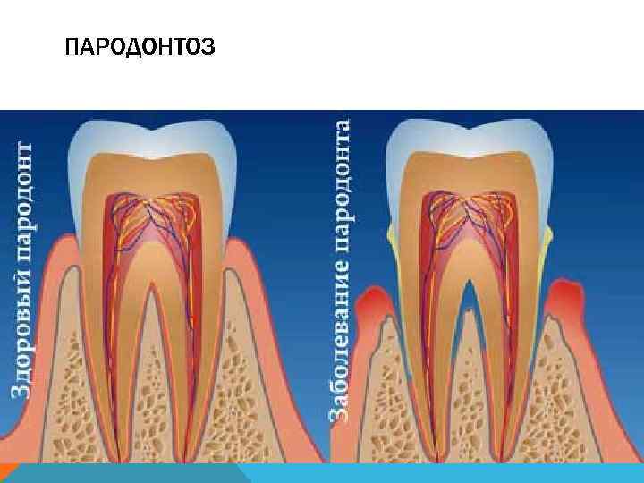 ПАРОДОНТОЗ 
