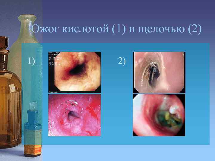 Ожог кислотой (1) и щелочью (2) 1) 2) 