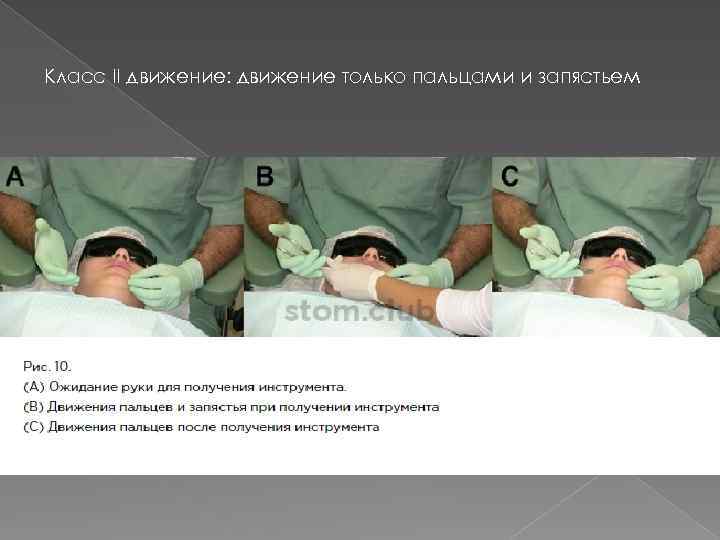 Класс II движение: движение только пальцами и запястьем 