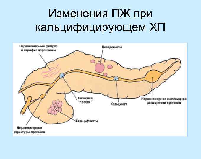 Характер стула при хроническом панкреатите