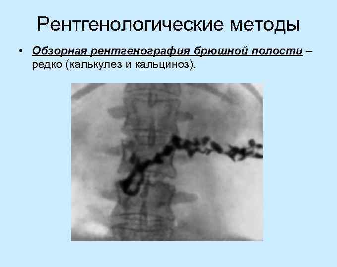 Рентгенологические методы • Обзорная рентгенография брюшной полости – редко (калькулез и кальциноз). 