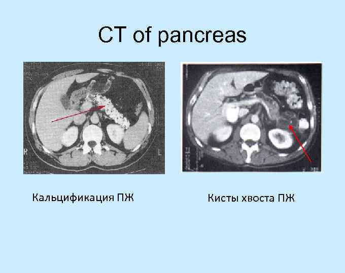 CT of pancreas Кальцификация ПЖ Кисты хвоста ПЖ 