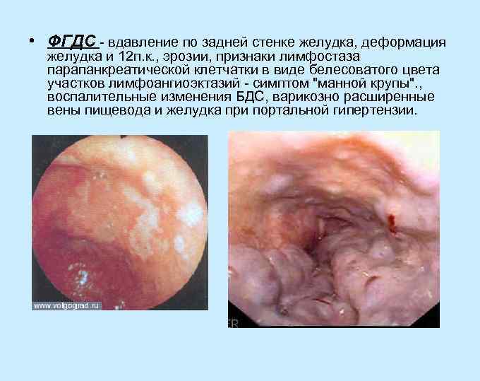  • ФГДС - вдавление по задней стенке желудка, деформация желудка и 12 п.