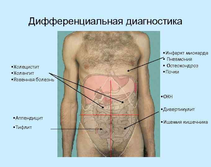 Дифференциальная диагностика • Холецистит • Холангит • Язвенная болезнь • Инфаркт миокарда • Пневмония