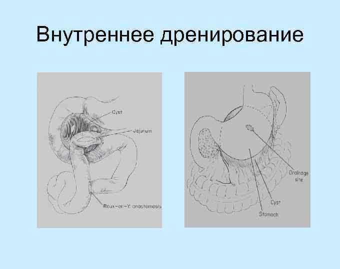 Внутреннее дренирование 