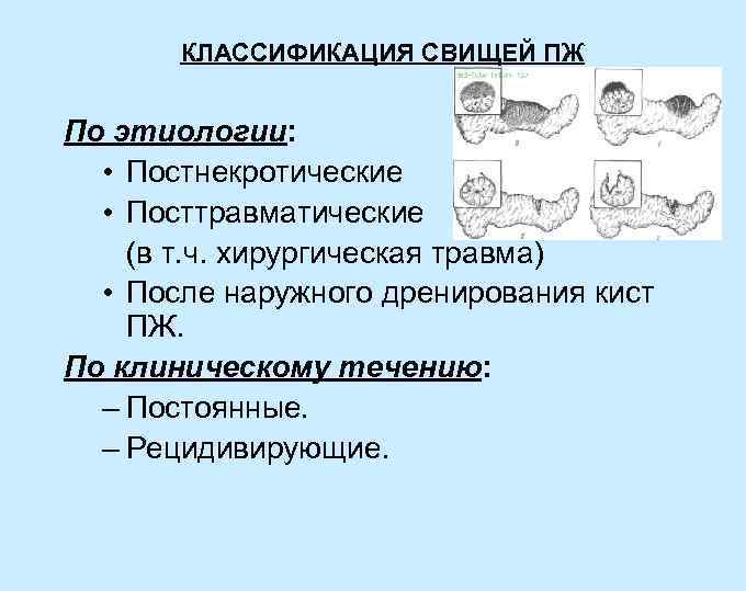 КЛАССИФИКАЦИЯ СВИЩЕЙ ПЖ По этиологии: • Постнекротические • Посттравматические (в т. ч. хирургическая травма)
