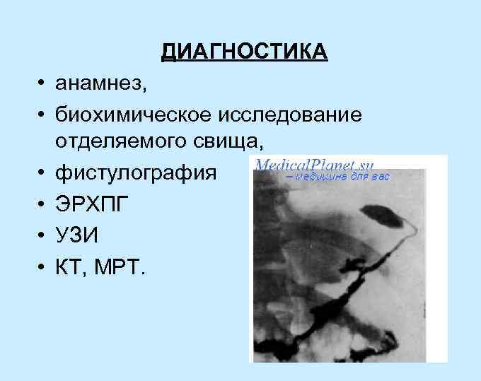 ДИАГНОСТИКА • анамнез, • биохимическое исследование отделяемого свища, • фистулография • ЭРХПГ • УЗИ