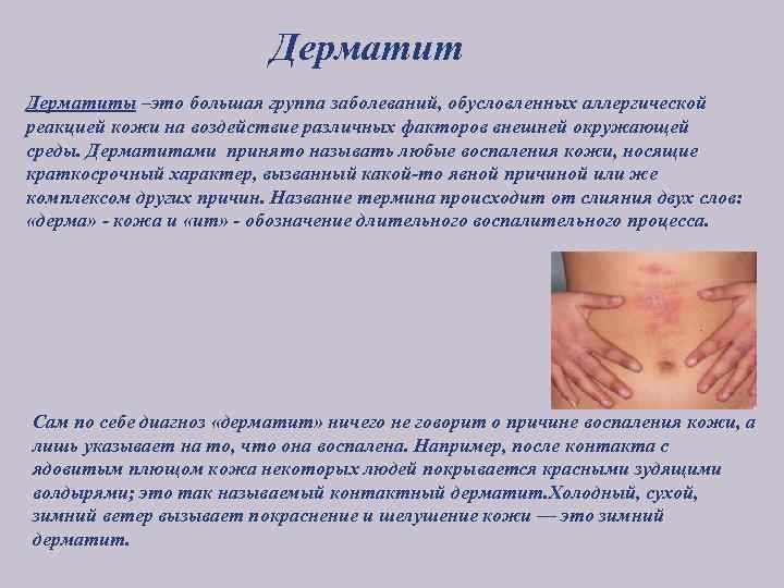 Дерматиты –это большая группа заболеваний, обусловленных аллергической реакцией кожи на воздействие различных факторов внешней