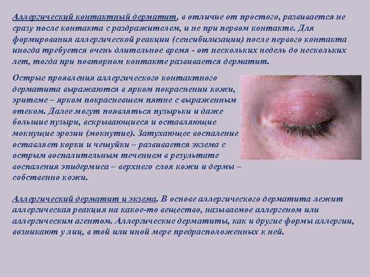 Аллергический контактный дерматит, в отличие от простого, развивается не сразу после контакта с раздражителем,