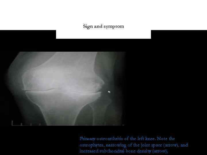 Sign and symptom Primary osteoarthritis of the left knee. Note the osteophytes, narrowing of