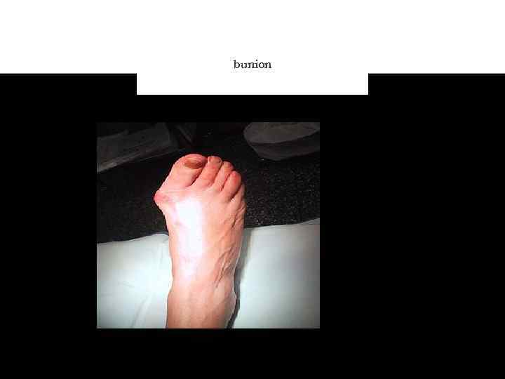 bunion 