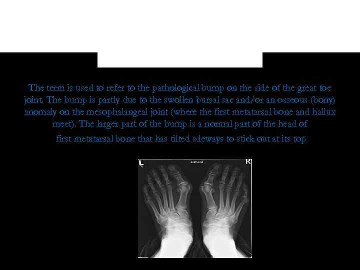 The term is used to refer to the pathological bump on the side of