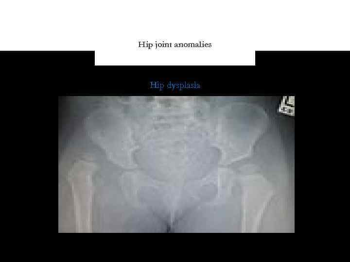 Hip joint anomalies Hip dysplasia 