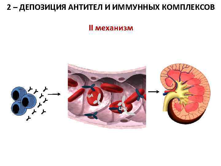 2 – ДЕПОЗИЦИЯ АНТИТЕЛ И ИММУННЫХ КОМПЛЕКСОВ II механизм Ig. A Ig. G ЦИК