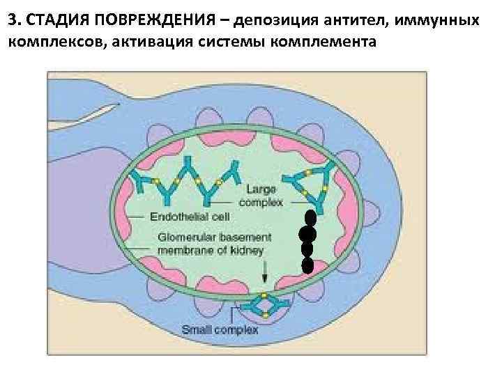 3. СТАДИЯ ПОВРЕЖДЕНИЯ – депозиция антител, иммунных комплексов, активация системы комплемента 