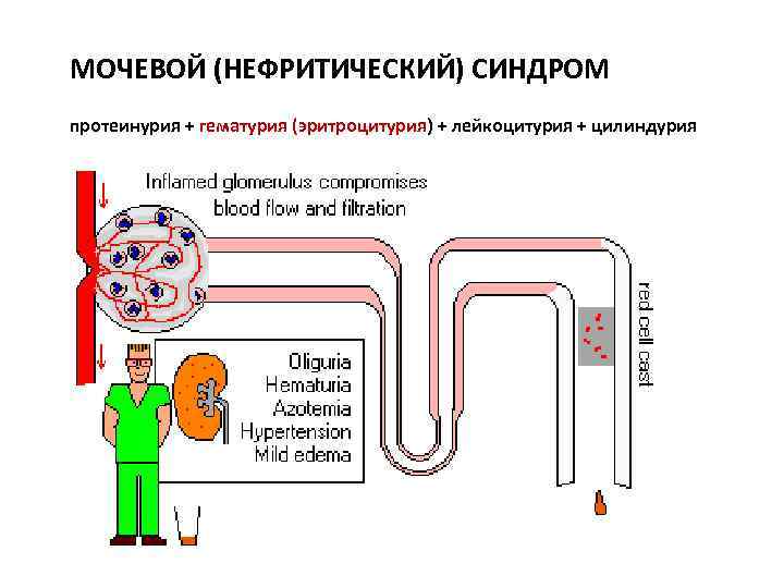 МОЧЕВОЙ (НЕФРИТИЧЕСКИЙ) СИНДРОМ протеинурия + гематурия (эритроцитурия) + лейкоцитурия + цилиндурия 