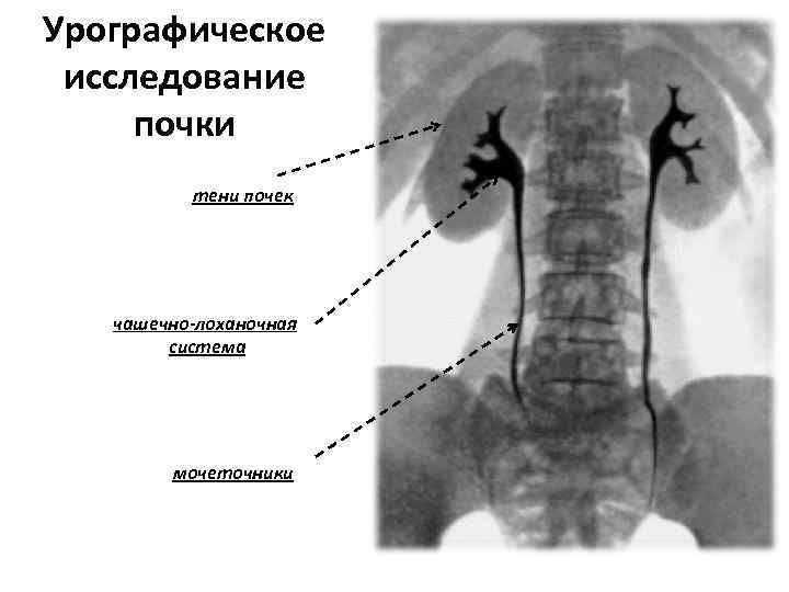 Урографическое исследование почки тени почек чашечно-лоханочная система мочеточники 