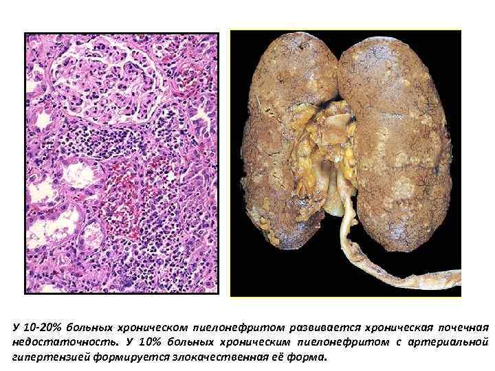 У 10 -20% больных хроническом пиелонефритом развивается хроническая почечная недостаточность. У 10% больных хроническим