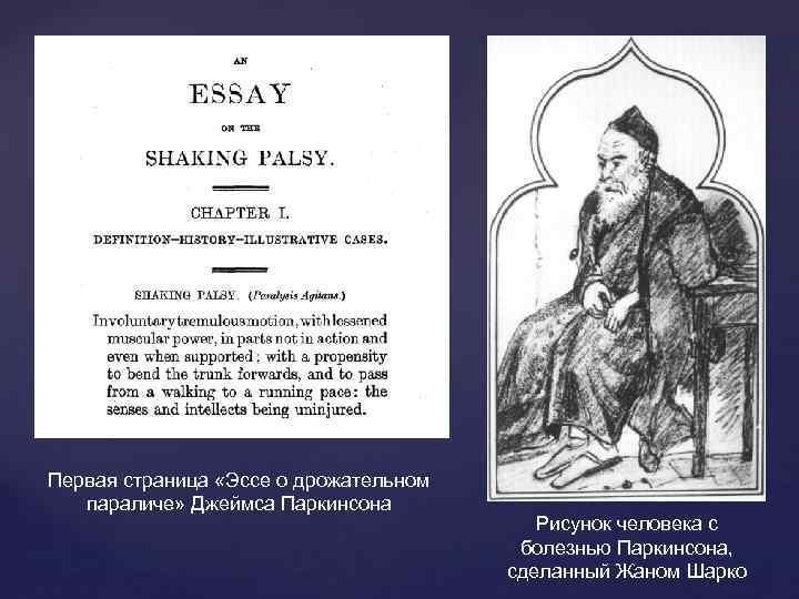 Первая страница «Эссе о дрожательном параличе» Джеймса Паркинсона Рисунок человека с болезнью Паркинсона, сделанный