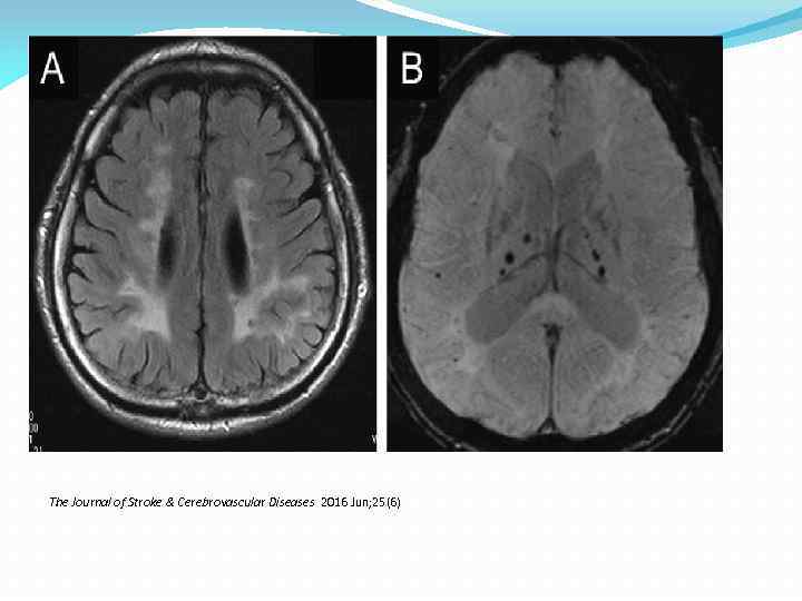 The Journal of Stroke & Cerebrovascular Diseases 2016 Jun; 25(6) 