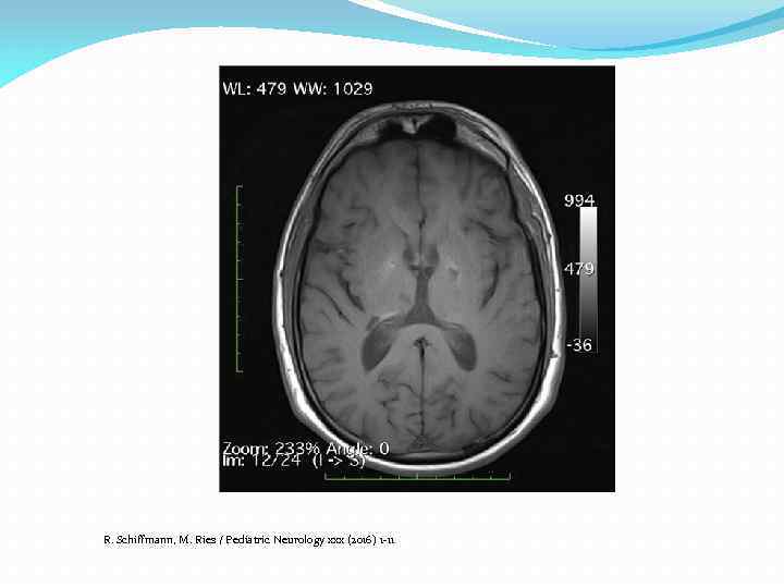 R. Schiffmann, M. Ries / Pediatric Neurology xxx (2016) 1 -11 