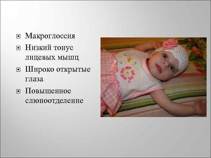  Макроглоссия Низкий тонус лицевых мышц Широко открытые глаза Повышенное слюноотделение 