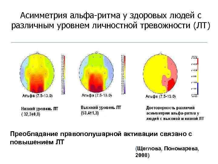 Асимметрия альфа-ритма у здоровых людей с различным уровнем личностной тревожности (ЛТ) Преобладание правополушарной активации