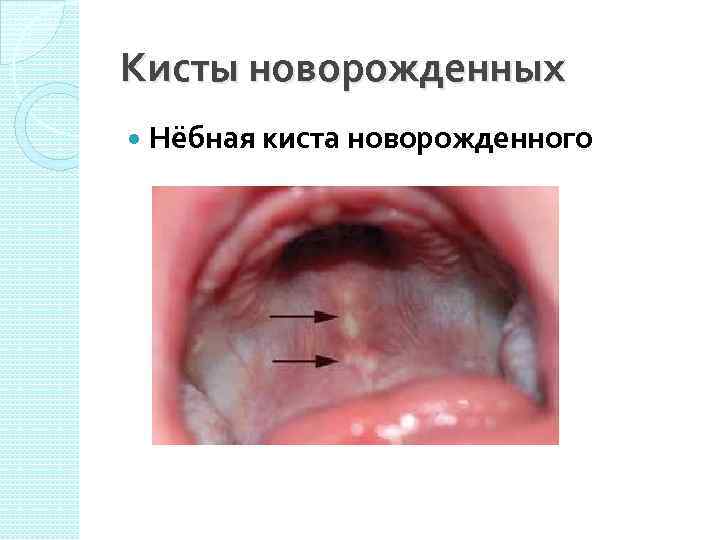 Кисты новорожденных Нёбная киста новорожденного 