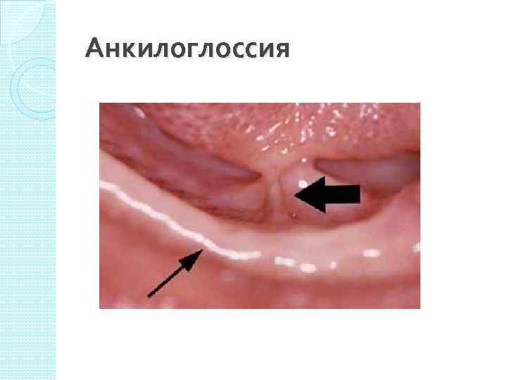 Анкилоглоссия 