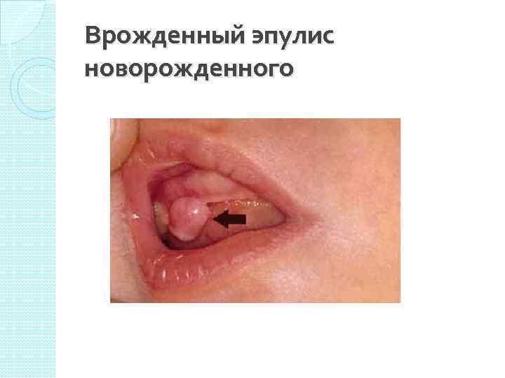 Врожденный эпулис новорожденного 