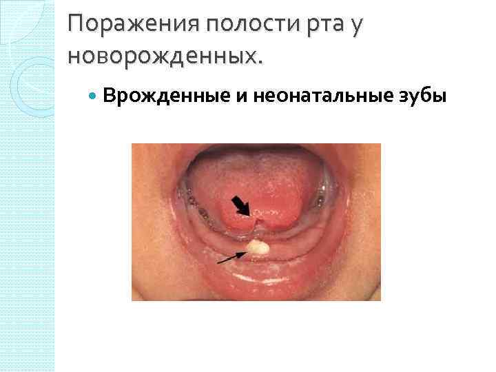 Поражения полости рта у новорожденных. Врожденные и неонатальные зубы 