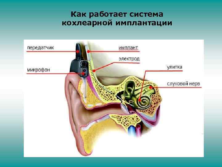 Как работает система кохлеарной имплантации 