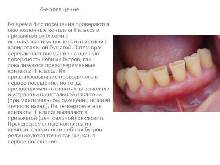 4 -е посещение Во время 4 -го посещения проверяются окклюзионные контакты II класса в