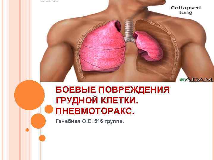 БОЕВЫЕ ПОВРЕЖДЕНИЯ ГРУДНОЙ КЛЕТКИ. ПНЕВМОТОРАКС. Ганебная О. Е. 516 группа. 