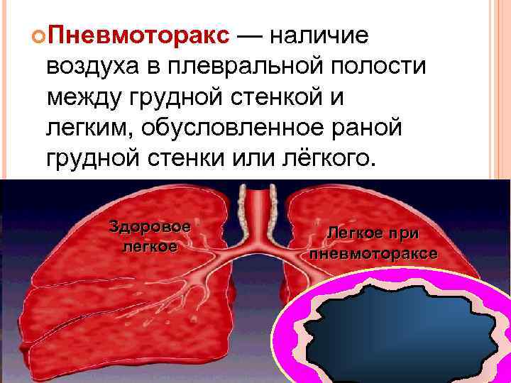  Пневмоторакс — наличие воздуха в плевральной полости между грудной стенкой и легким, обусловленное