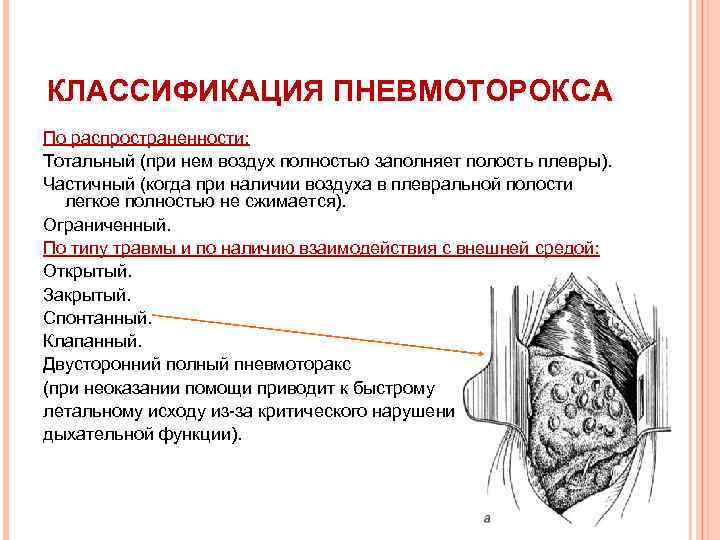 КЛАССИФИКАЦИЯ ПНЕВМОТОРОКСА По распространенности: Тотальный (при нем воздух полностью заполняет полость плевры). Частичный (когда