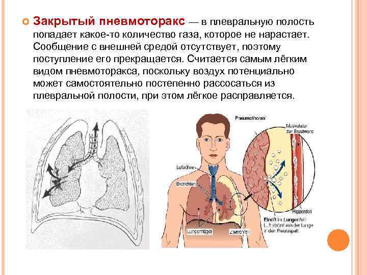  Закрытый пневмоторакс — в плевральную полость попадает какое-то количество газа, которое не нарастает.