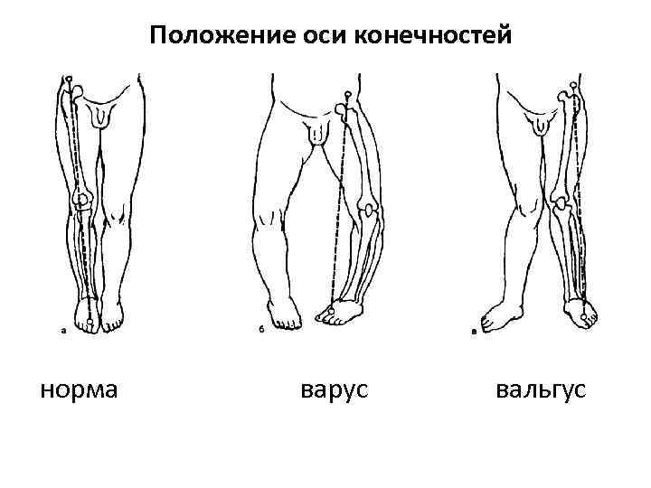 Положение оси конечностей норма варус вальгус 